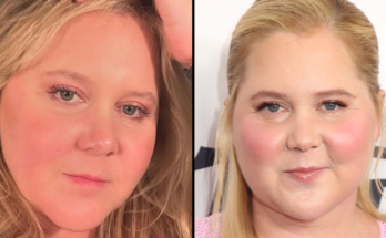 Amy Schumer Says Cruel ‘Moon Face’ Comments Led To Shock Health Diagnosis