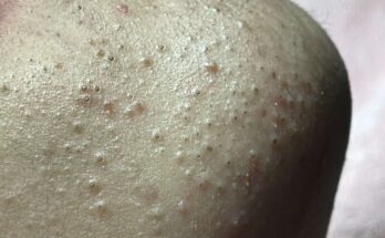 Make Acne With Me !!! – Acnes Treatments Mai Ngoc 💕💕💕