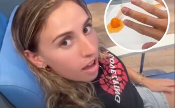 Woman issues urgent warning against picking the skin on your fingers after 'traumatizing' outcome landed her in hospital