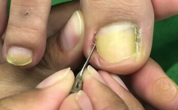 Ingrown Nail Tools [ Relaxing Cleaning Nail ]