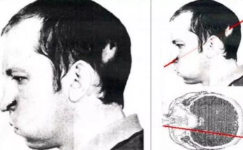 Concerning effects scientist faced after proton beam went through his head with hundreds of fatal doses of radiation