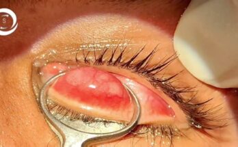 Chalazion Surgery: Everything You Need to Know