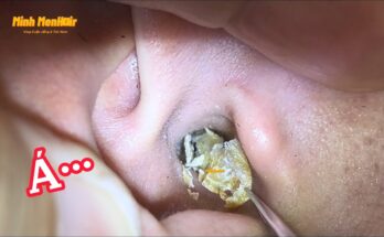 Earwax Removal 101: The Best (and Safest) Ways to Clear Clogged Ears