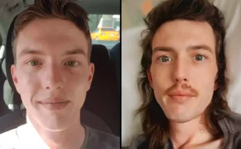 Man, 28, Dies Suddenly With 72 Holes In His Lungs