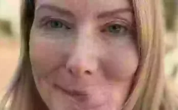 Woman's date ends in horror after she pets stranger's dog and gets lips ripped off